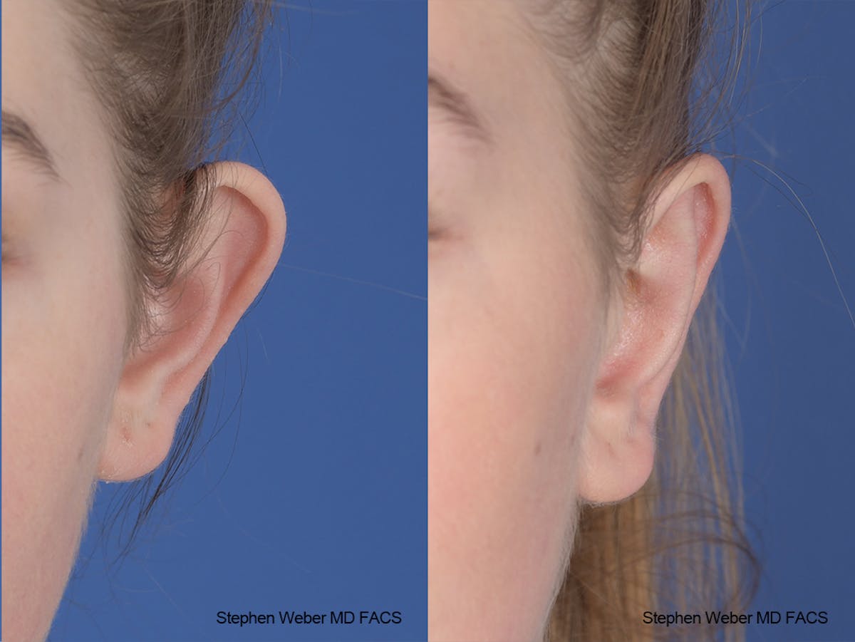 Otoplasty Before & After Gallery - Patient 186785 - Image 1