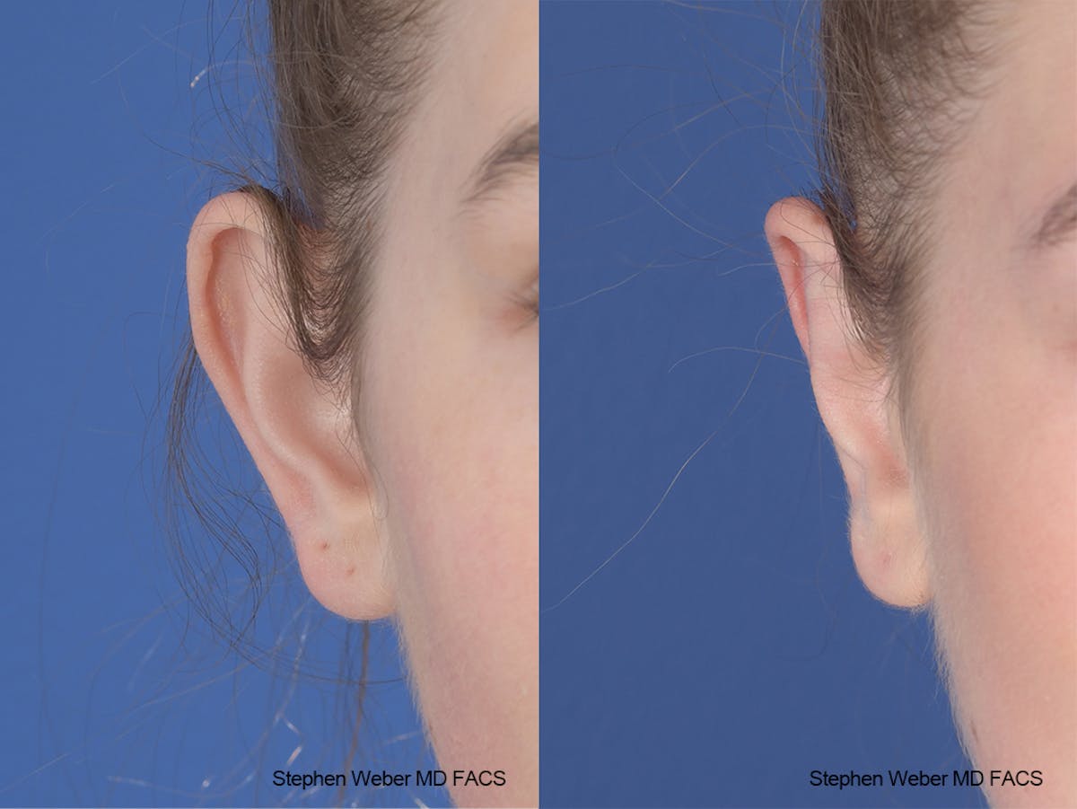 Otoplasty Before & After Gallery - Patient 186785 - Image 2