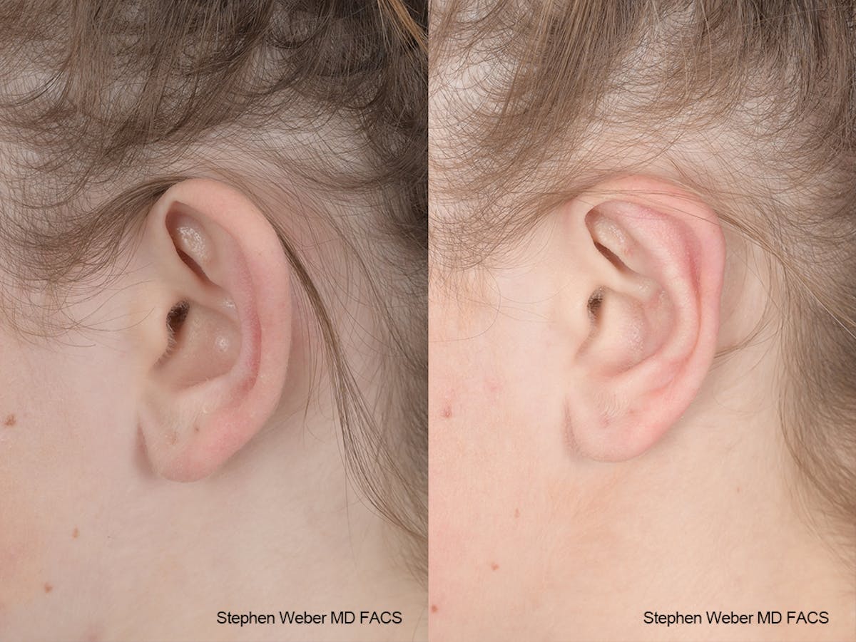 Otoplasty Before & After Gallery - Patient 186785 - Image 3