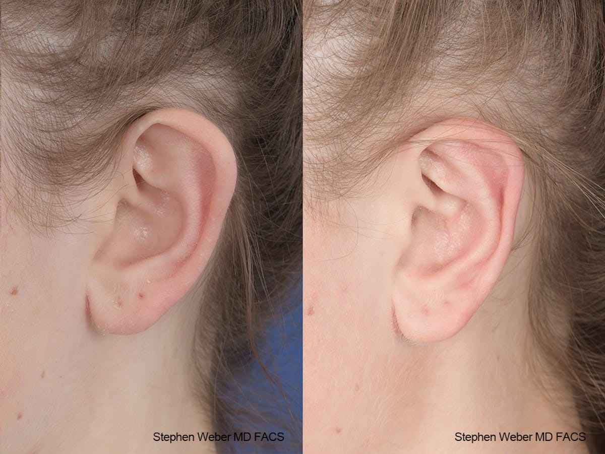 Otoplasty Before & After Gallery - Patient 186785 - Image 4