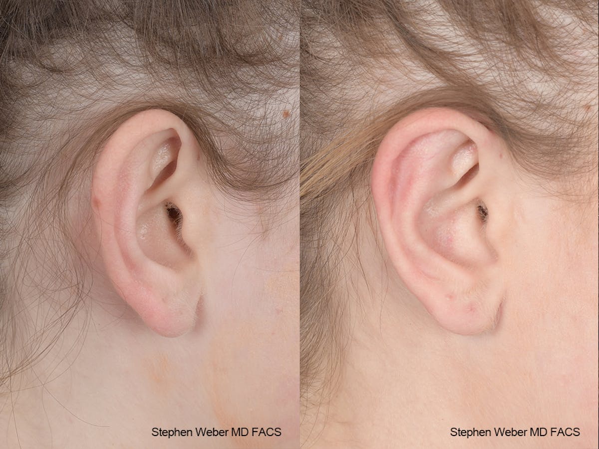 Otoplasty Before & After Gallery - Patient 186785 - Image 5