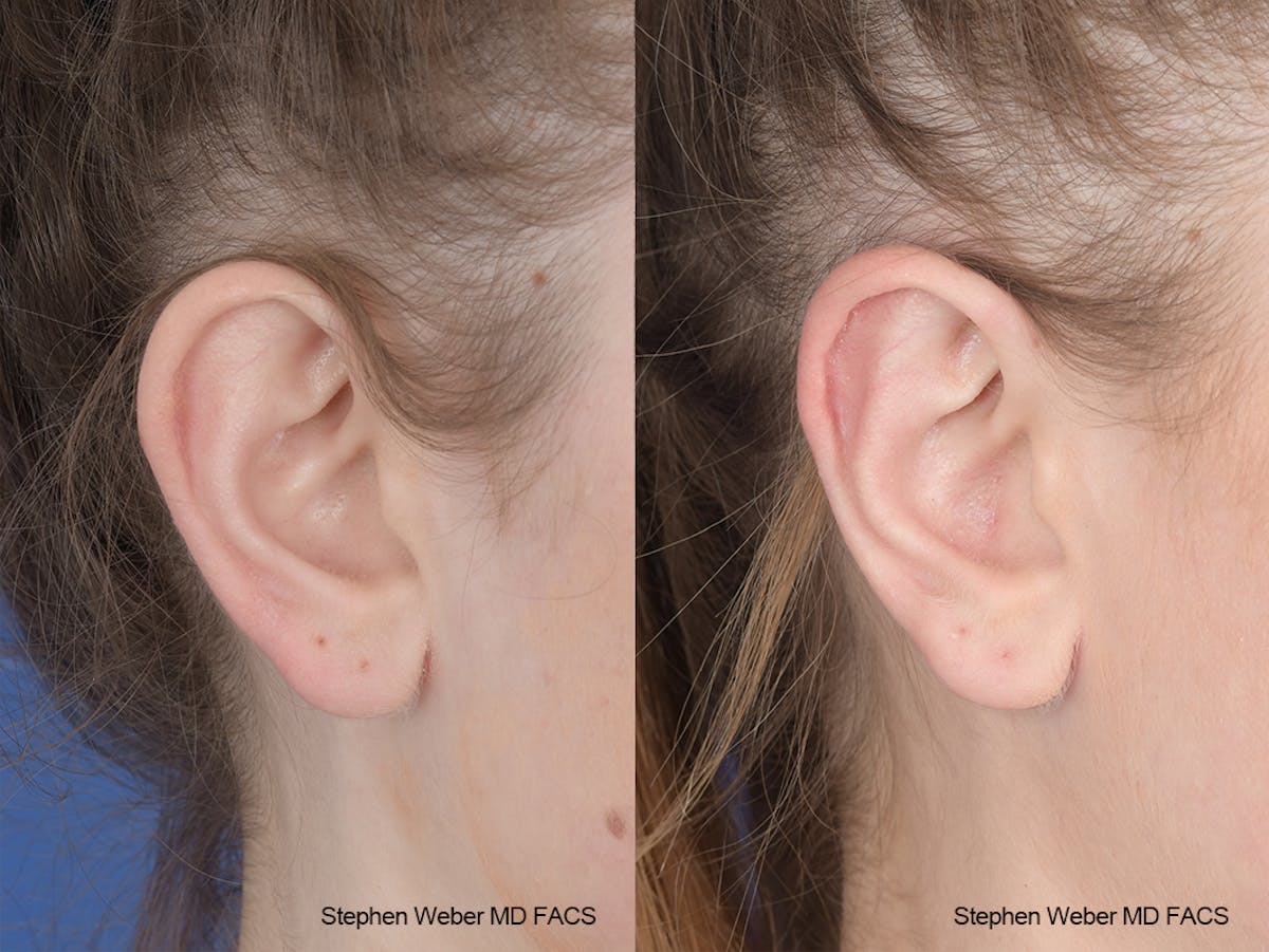 Otoplasty Before & After Gallery - Patient 186785 - Image 6