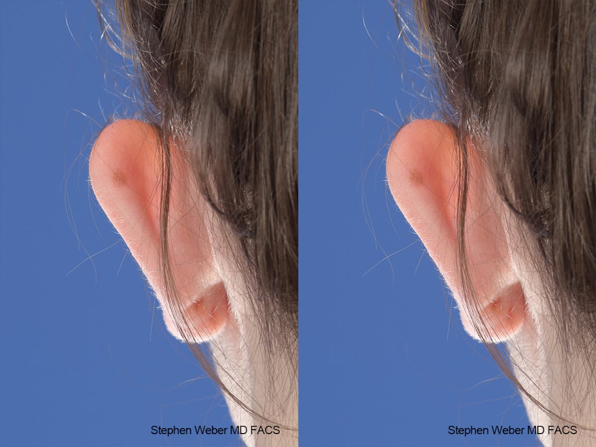 Otoplasty Before & After Gallery - Patient 186785 - Image 7