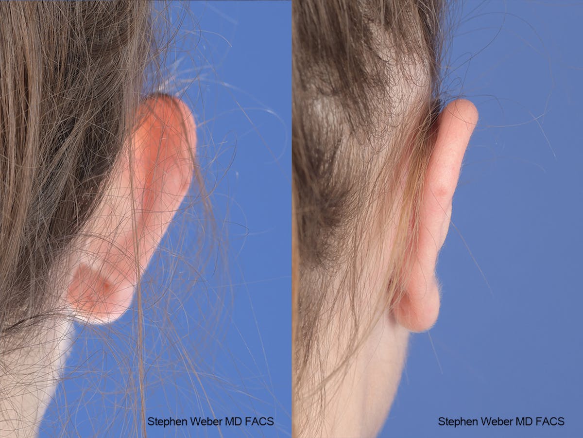 Otoplasty Before & After Gallery - Patient 186785 - Image 8