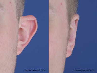 Otoplasty Before & After Gallery - Patient 137484 - Image 1