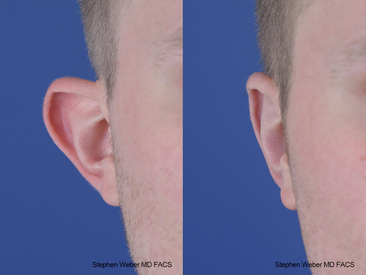 Otoplasty Before & After Gallery - Patient 137484 - Image 2
