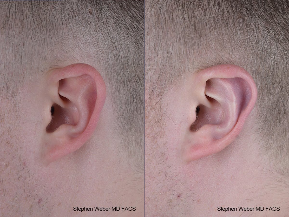 Otoplasty Before & After Gallery - Patient 137484 - Image 3