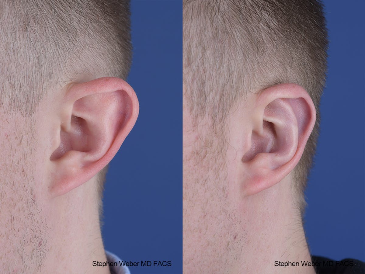 Otoplasty Before & After Gallery - Patient 137484 - Image 4