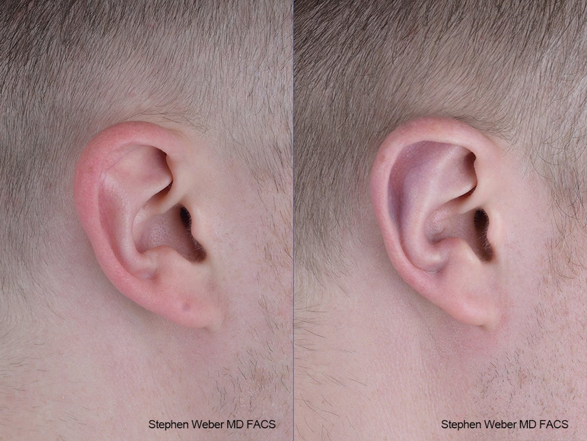 Otoplasty Before & After Gallery - Patient 137484 - Image 5