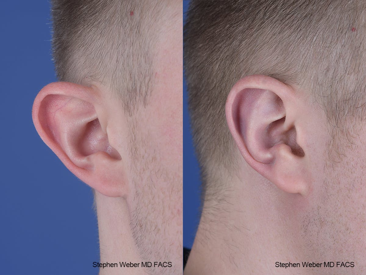 Otoplasty Before & After Gallery - Patient 137484 - Image 6