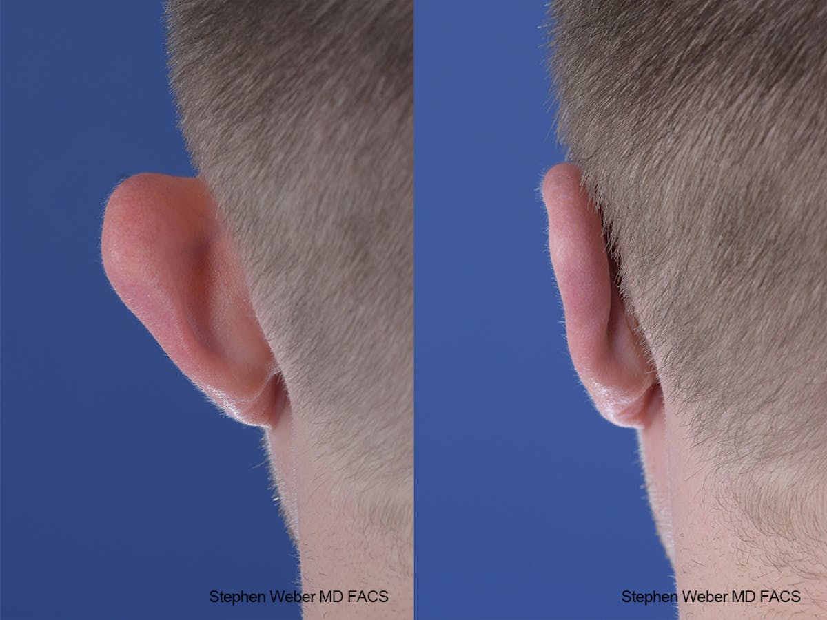 Otoplasty Before & After Gallery - Patient 137484 - Image 7