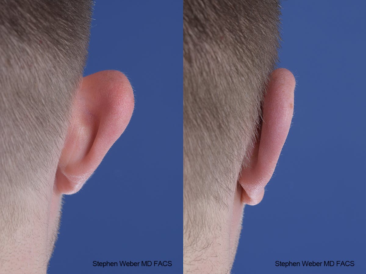Otoplasty Before & After Gallery - Patient 137484 - Image 8