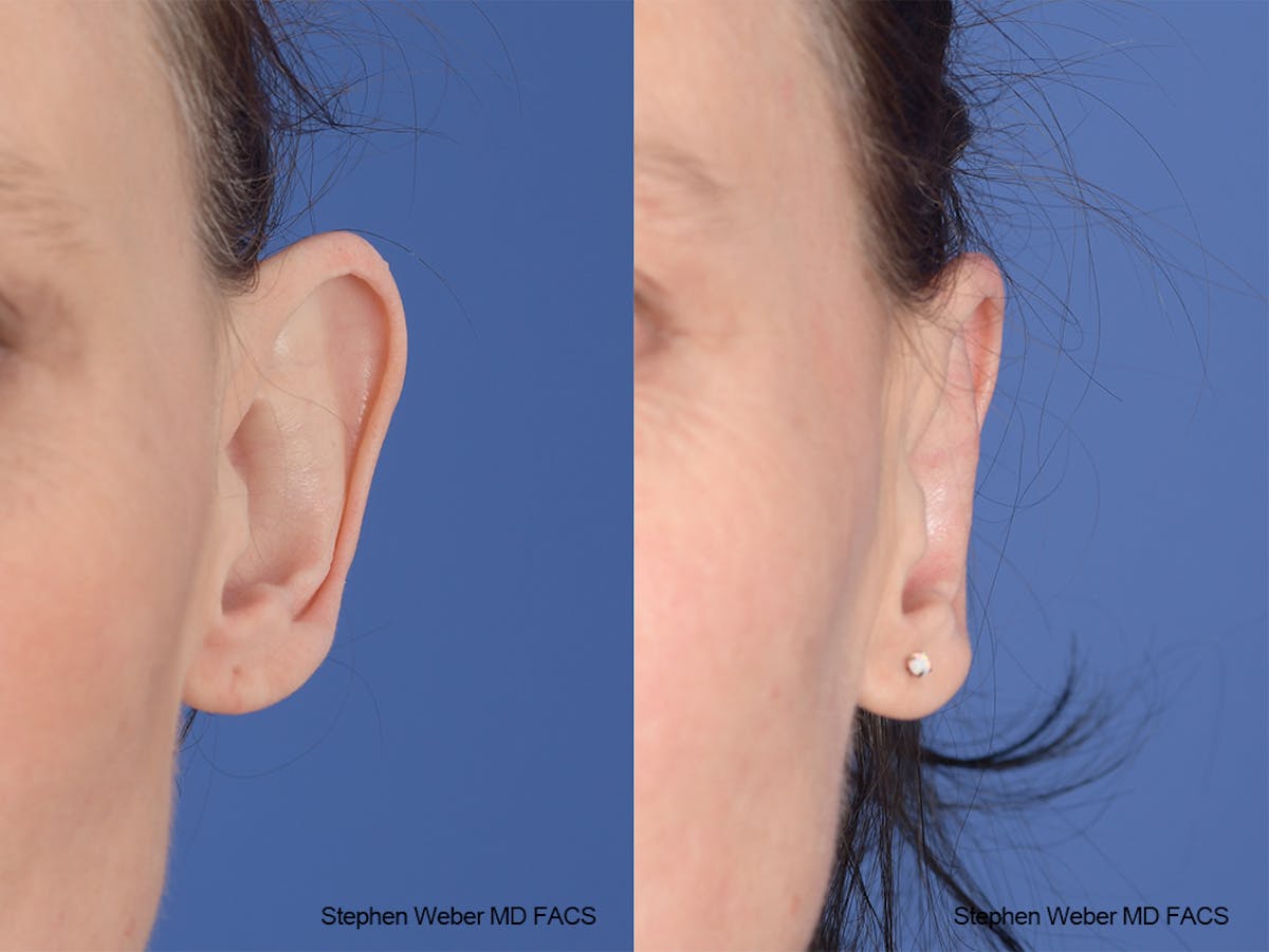 Otoplasty Before & After Gallery - Patient 139188 - Image 1