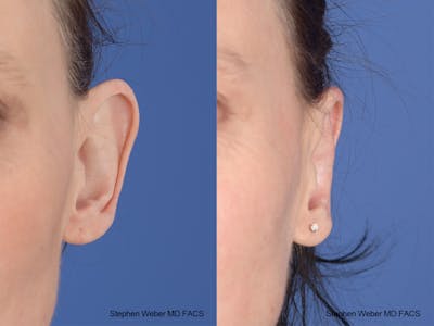 Otoplasty Before & After Gallery - Patient 139188 - Image 1