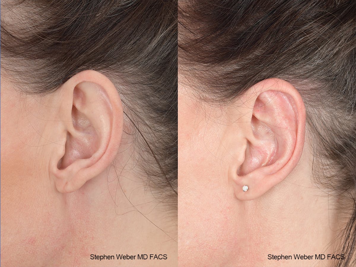 Otoplasty Before & After Gallery - Patient 139188 - Image 3