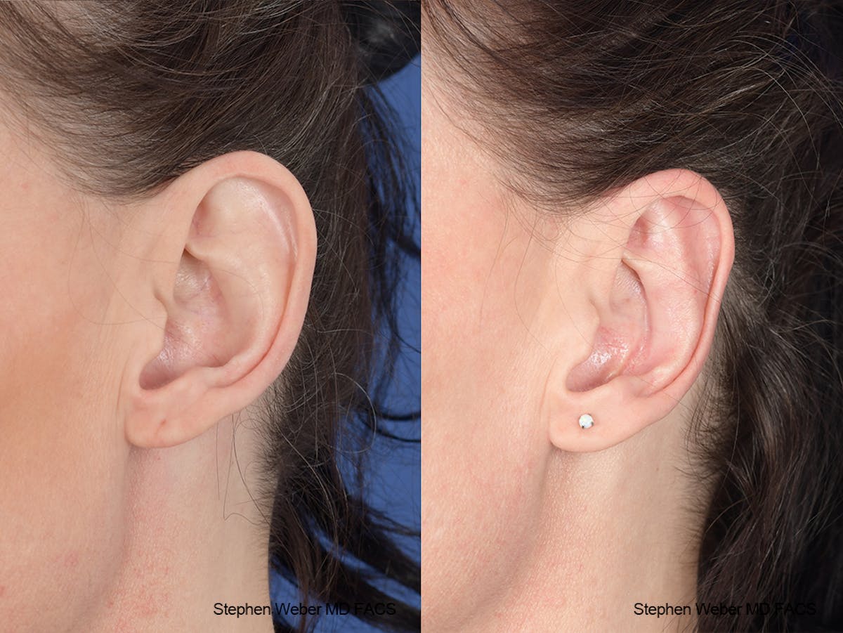 Otoplasty Before & After Gallery - Patient 139188 - Image 4