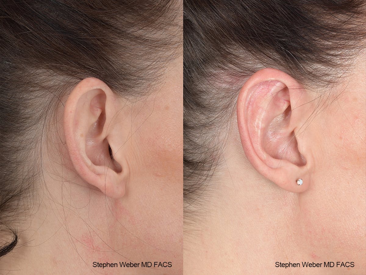 Otoplasty Before & After Gallery - Patient 139188 - Image 5