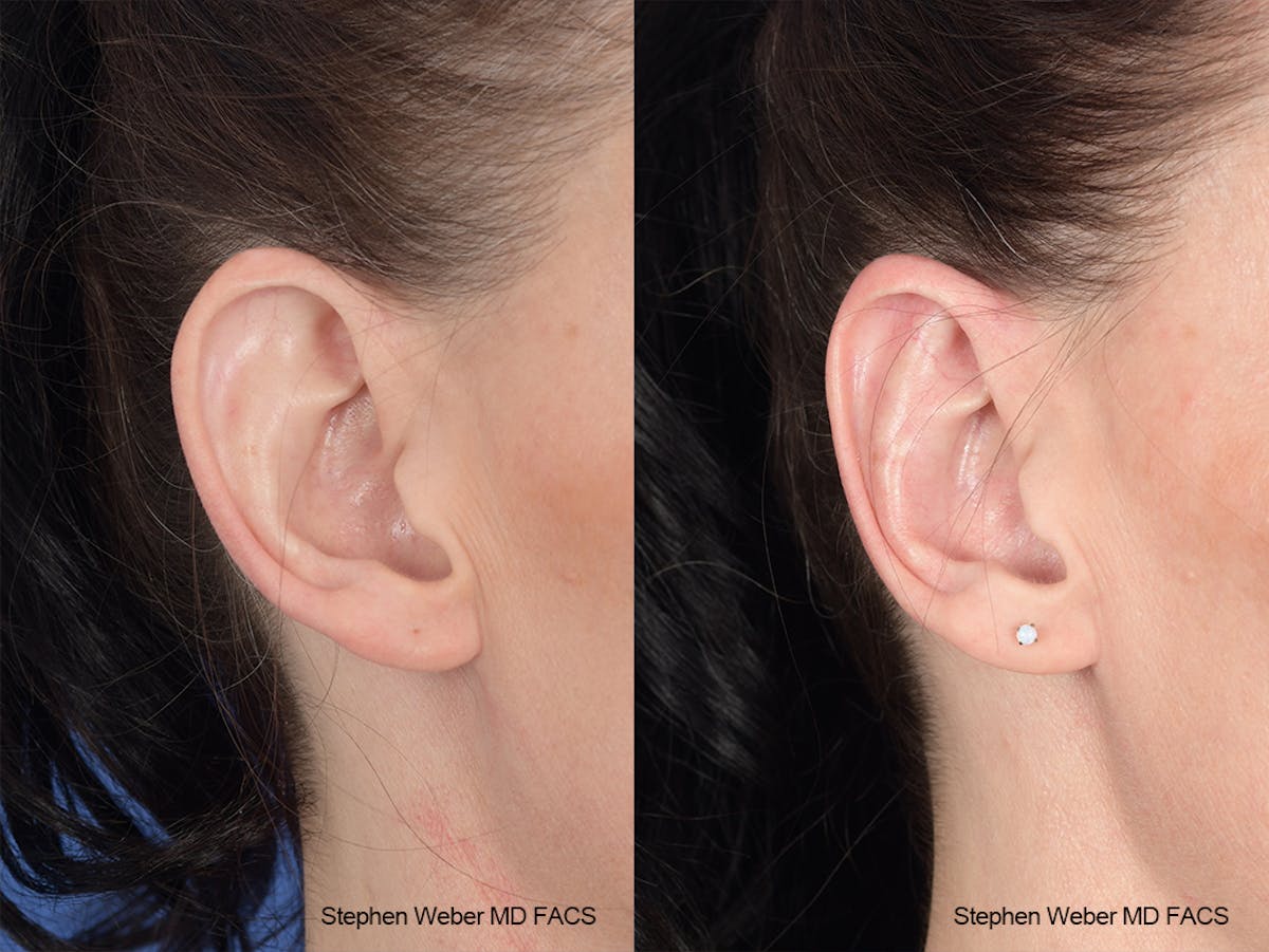 Otoplasty Before & After Gallery - Patient 139188 - Image 6