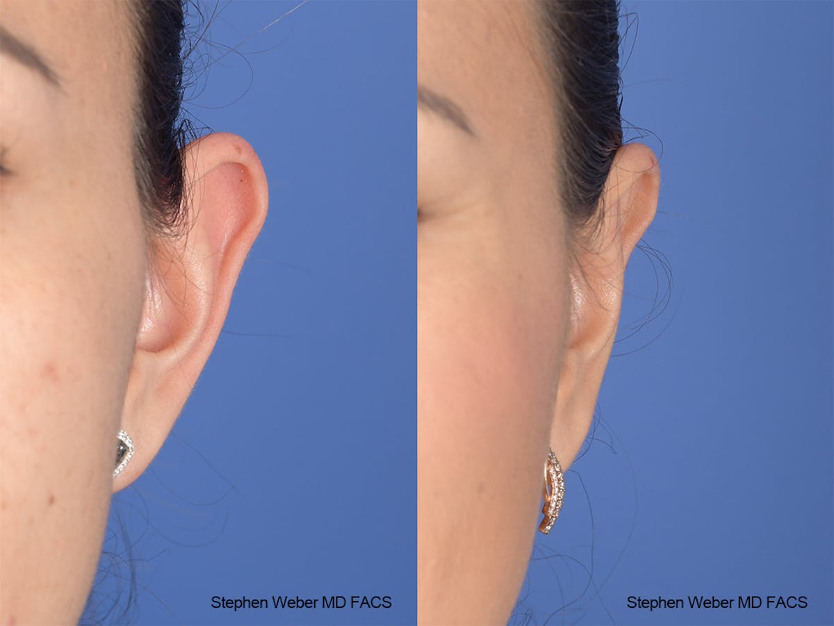 Otoplasty Before & After Gallery - Patient 970588 - Image 1