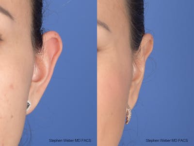 Otoplasty Before & After Gallery - Patient 970588 - Image 1