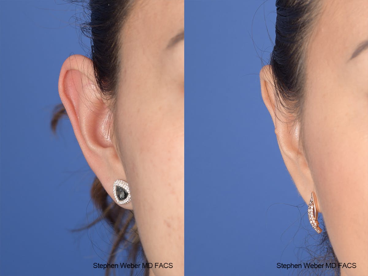 Otoplasty Before & After Gallery - Patient 970588 - Image 2