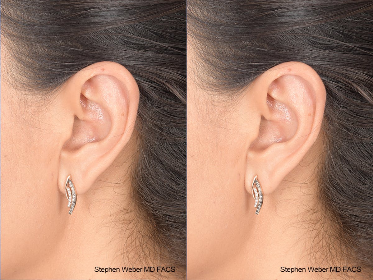 Otoplasty Before & After Gallery - Patient 970588 - Image 3