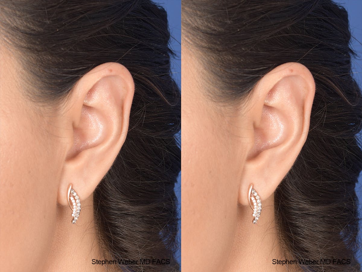 Otoplasty Before & After Gallery - Patient 970588 - Image 4