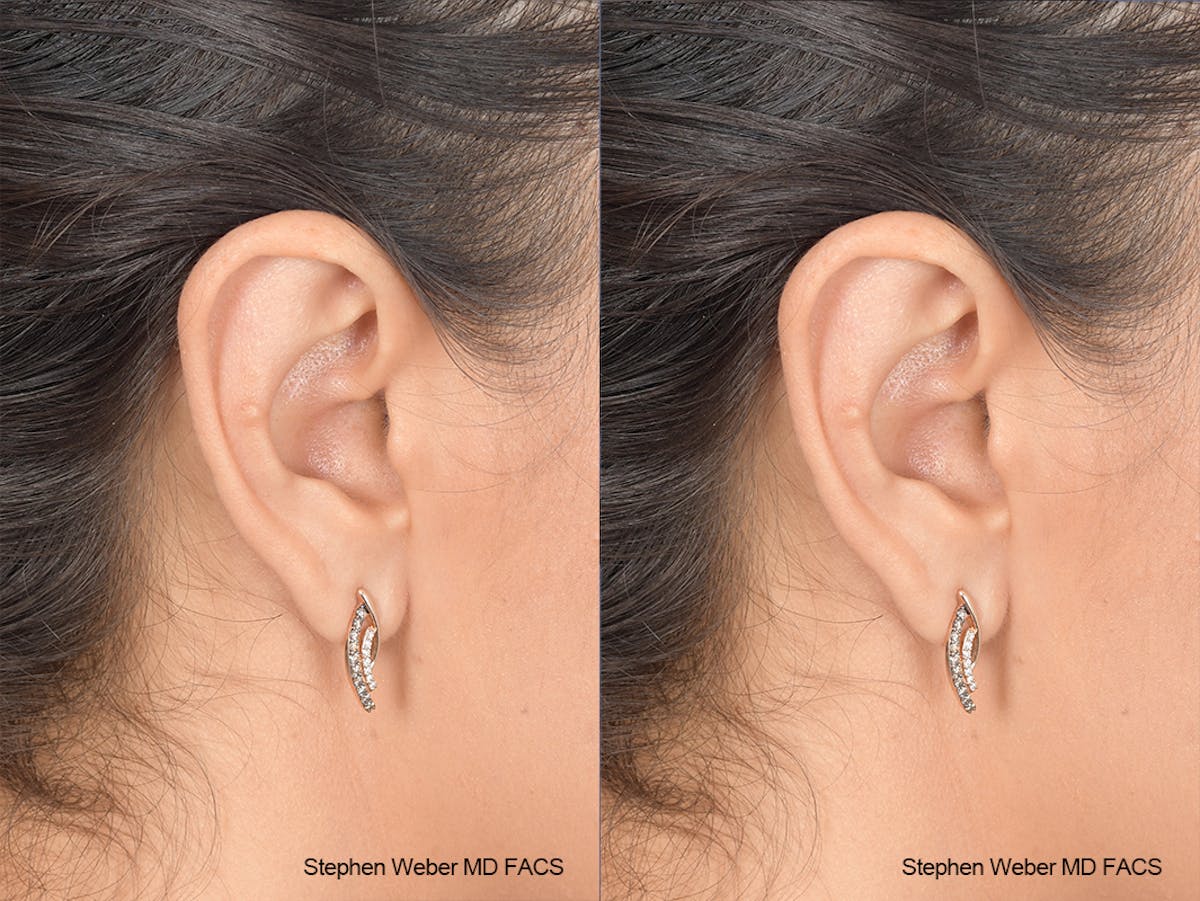 Otoplasty Before & After Gallery - Patient 970588 - Image 5