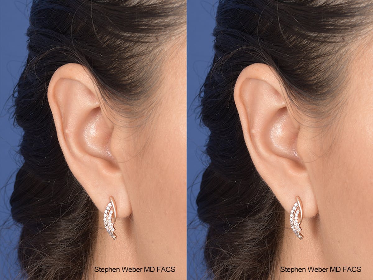 Otoplasty Before & After Gallery - Patient 970588 - Image 6