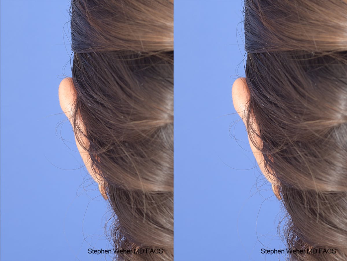 Otoplasty Before & After Gallery - Patient 970588 - Image 7