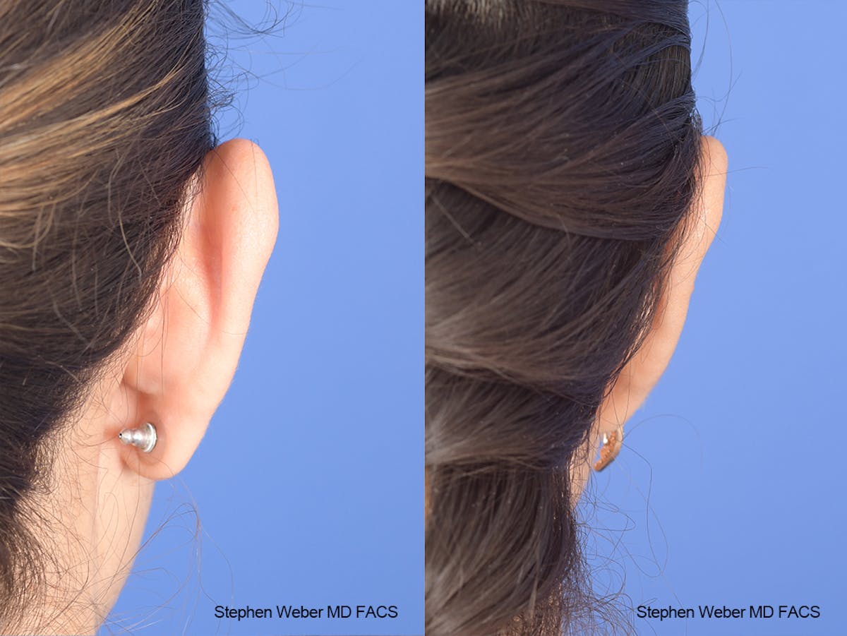 Otoplasty Before & After Gallery - Patient 970588 - Image 8