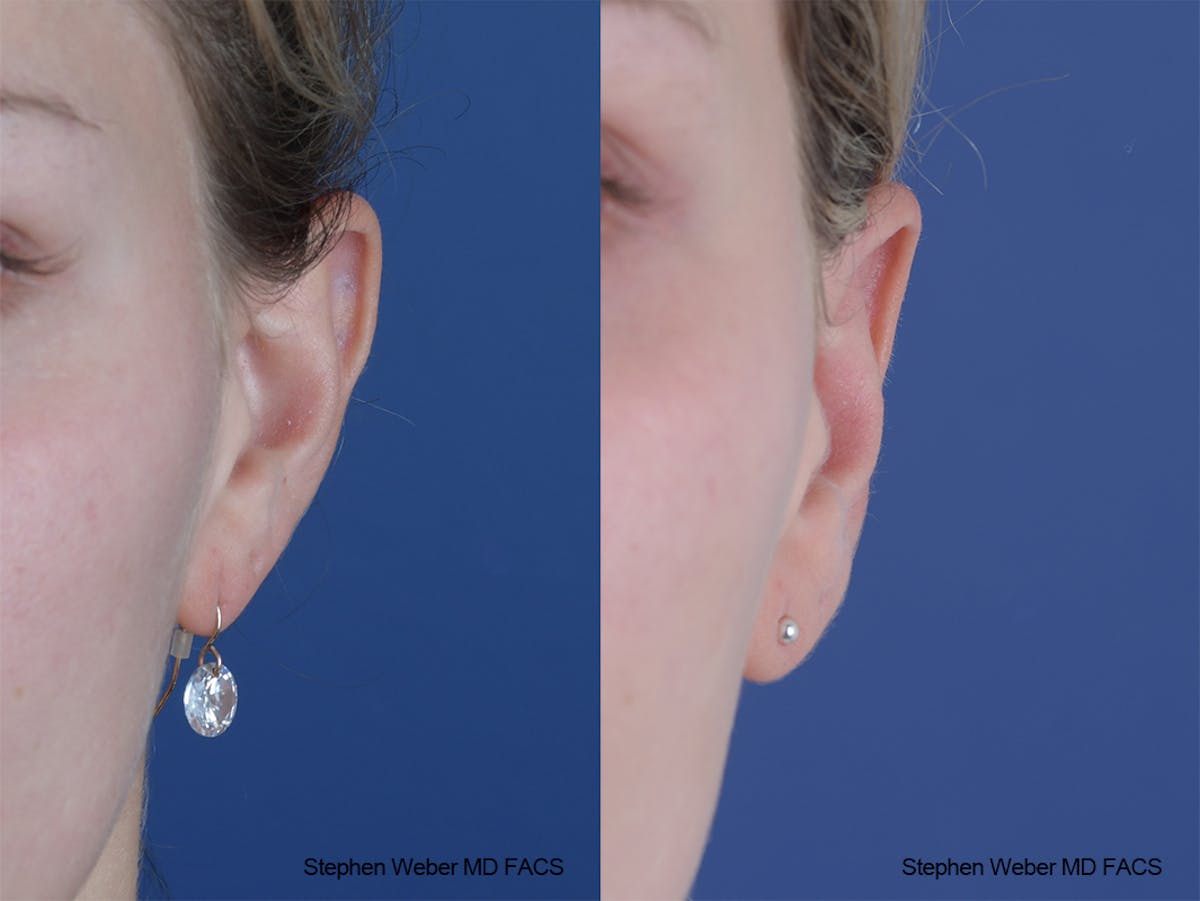 Otoplasty Before & After Gallery - Patient 250375 - Image 1