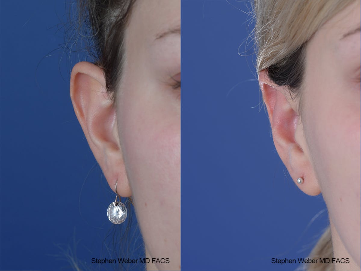 Otoplasty Before & After Gallery - Patient 250375 - Image 2