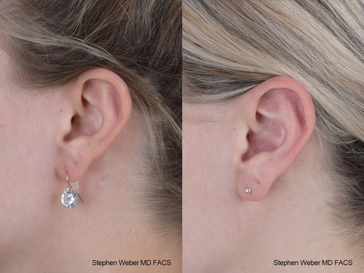 Otoplasty Before & After Gallery - Patient 250375 - Image 3