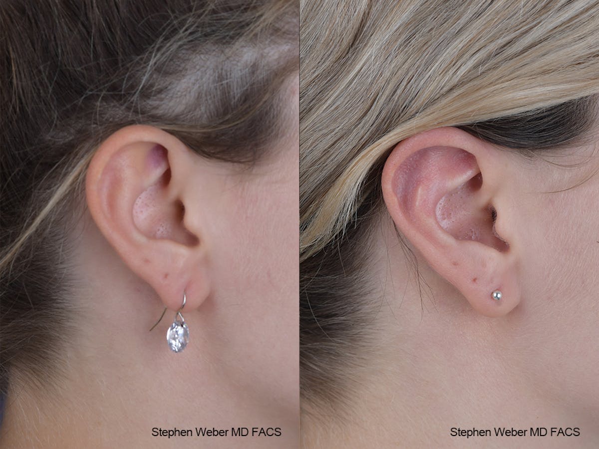 Otoplasty Before & After Gallery - Patient 250375 - Image 4
