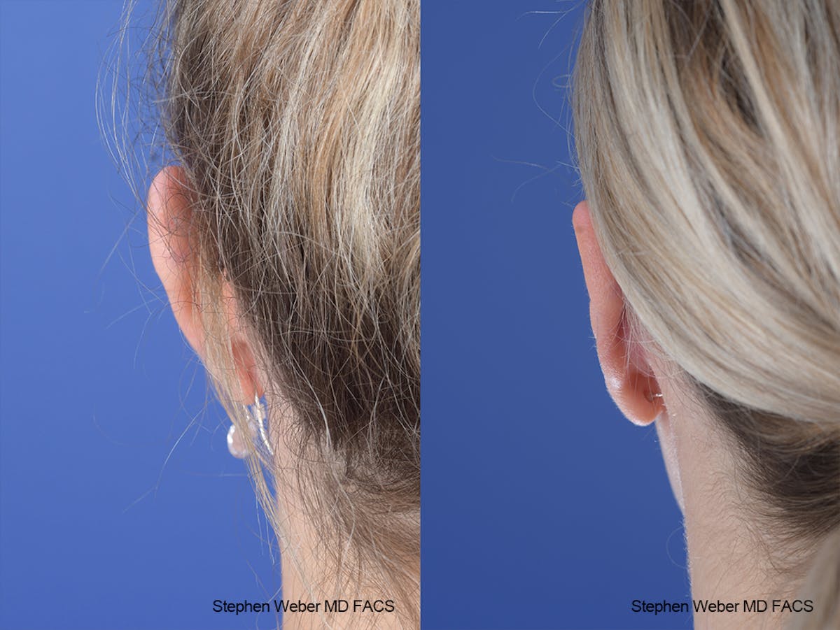 Otoplasty Before & After Gallery - Patient 250375 - Image 5