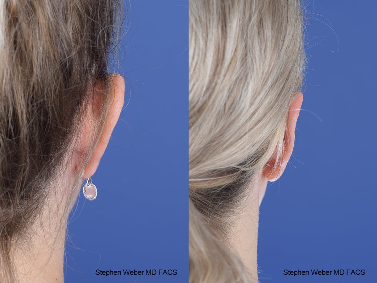 Otoplasty Before & After Gallery - Patient 250375 - Image 6