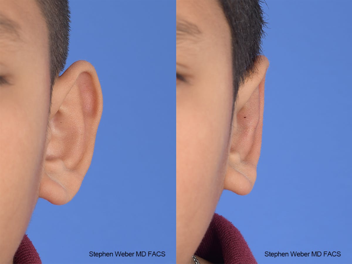 Otoplasty Before & After Gallery - Patient 292079 - Image 1