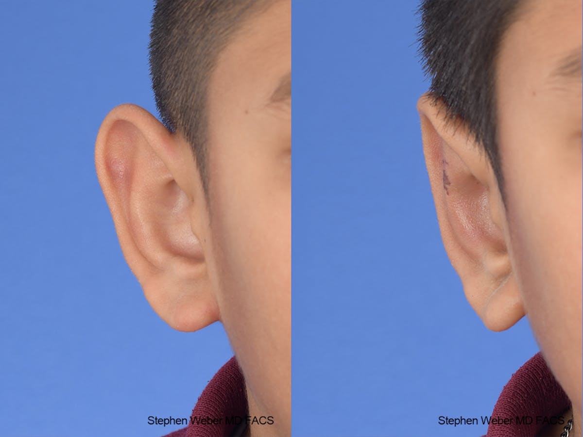 Otoplasty Before & After Gallery - Patient 292079 - Image 2