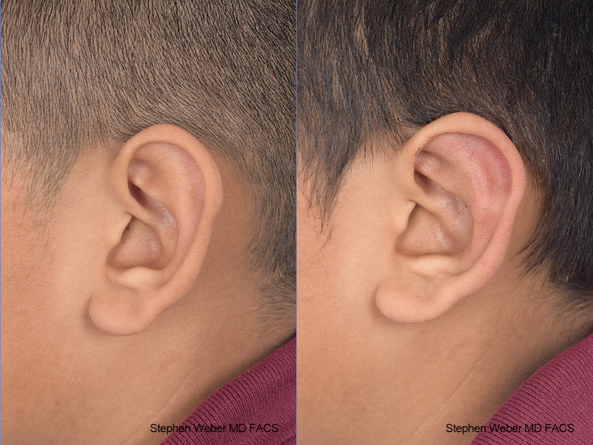Otoplasty Before & After Gallery - Patient 292079 - Image 3