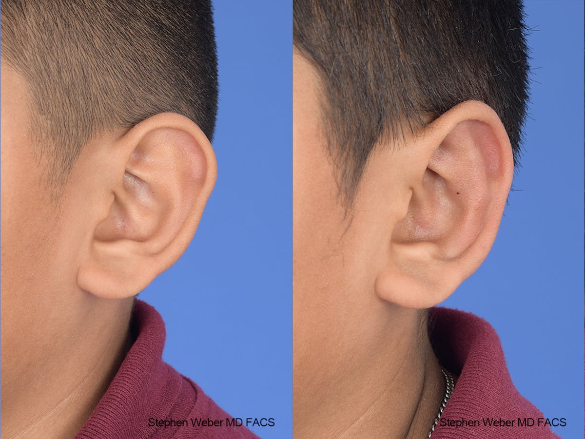 Otoplasty Before & After Gallery - Patient 292079 - Image 4