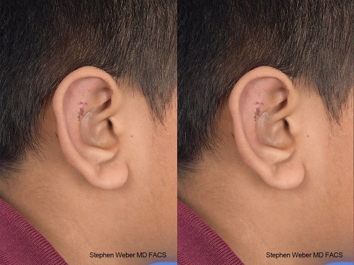 Otoplasty Before & After Gallery - Patient 292079 - Image 5