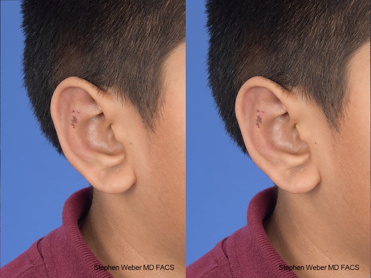 Otoplasty Before & After Gallery - Patient 292079 - Image 6