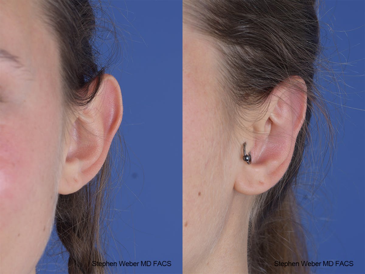 Otoplasty Before & After Gallery - Patient 253042 - Image 1