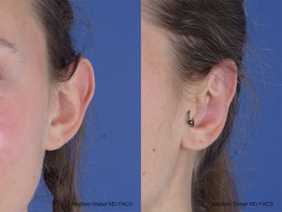 Otoplasty Before & After Gallery - Patient 253042 - Image 1