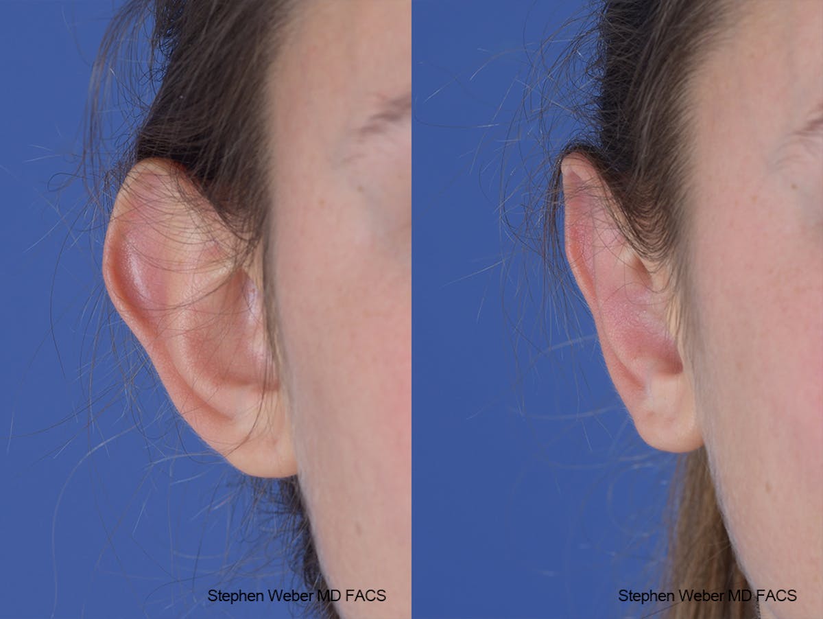 Otoplasty Before & After Gallery - Patient 253042 - Image 2