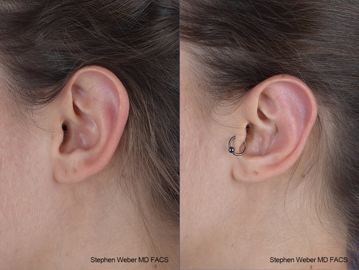 Otoplasty Before & After Gallery - Patient 253042 - Image 3