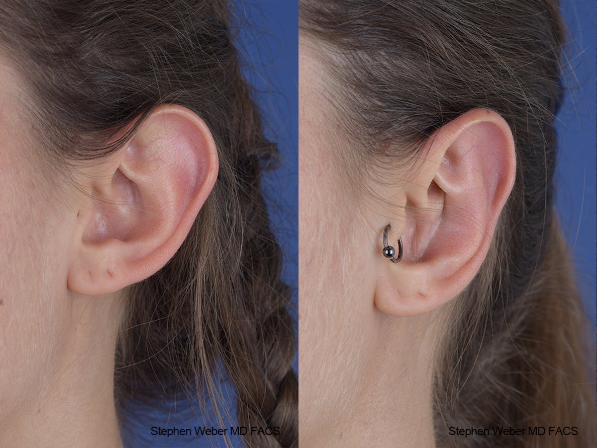 Otoplasty Before & After Gallery - Patient 253042 - Image 4