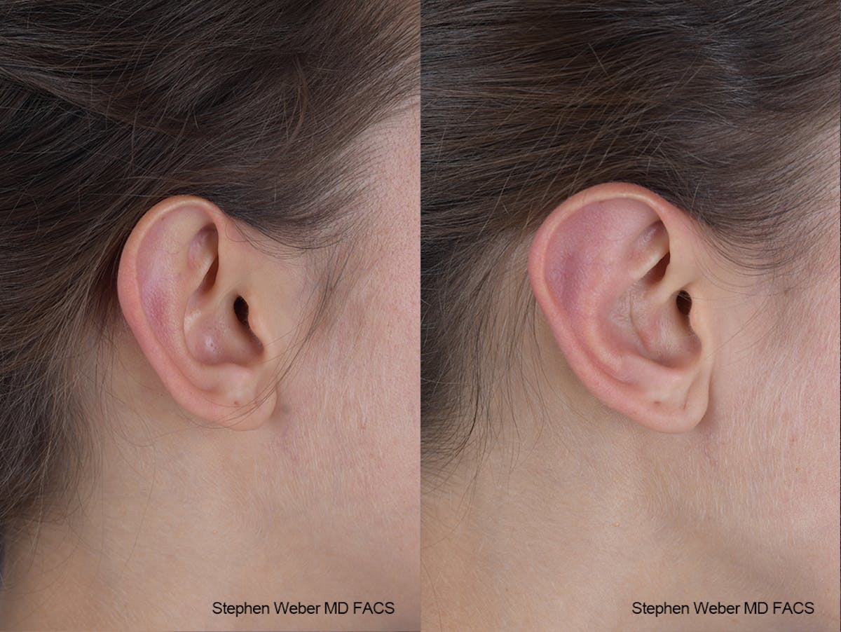 Otoplasty Before & After Gallery - Patient 253042 - Image 5