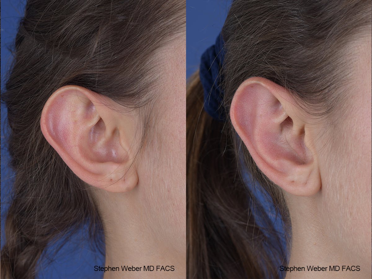 Otoplasty Before & After Gallery - Patient 253042 - Image 6
